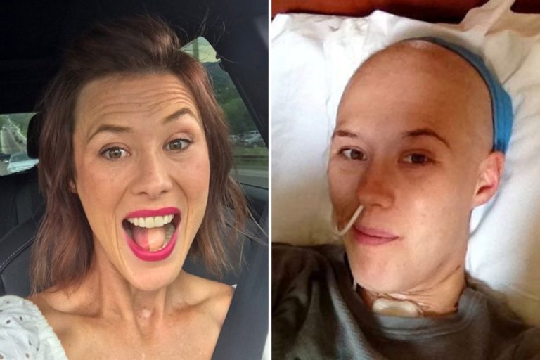 Woman’s tongue replaced with thigh to fight cancer